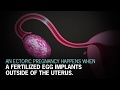 What is Ectopic Pregnancy?