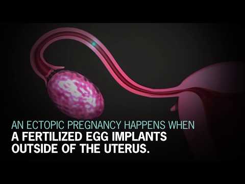 Video: ❶ Ectopic Pregnancy: How To Define It