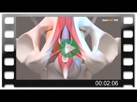 DynaMesh-PRM visible – Animation: Male Stress Incontinence