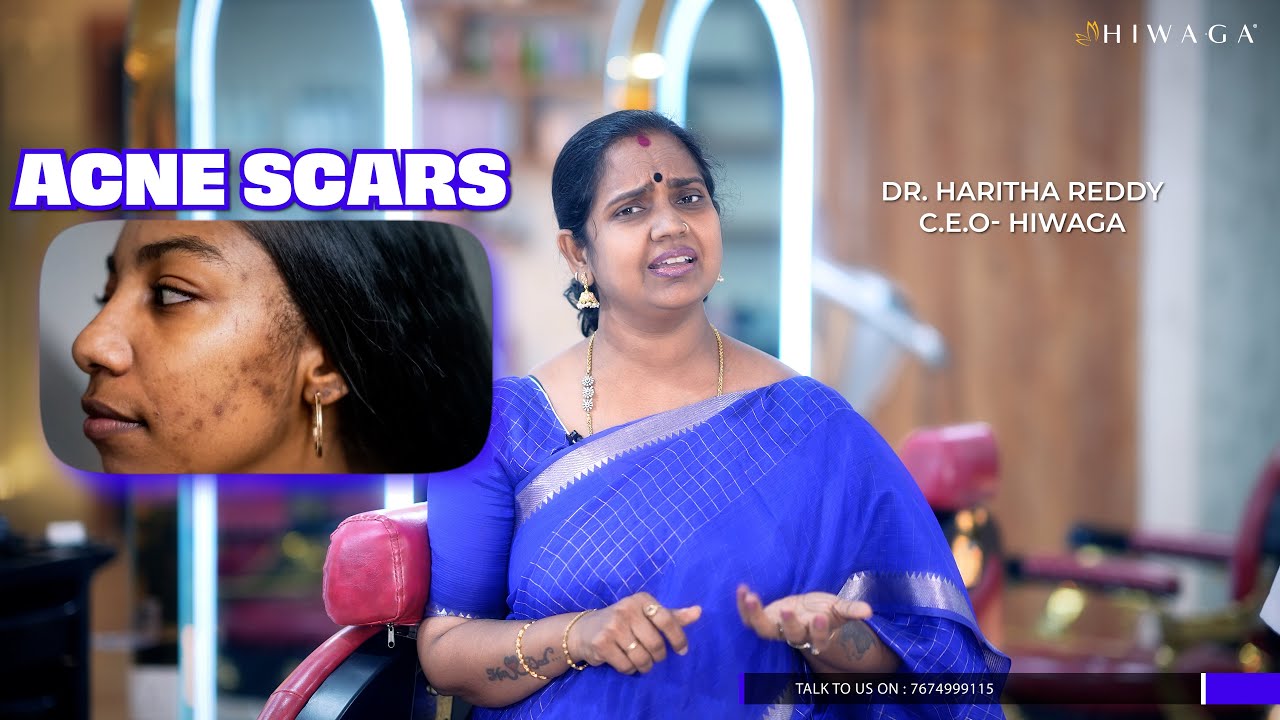 Expert Discussion on Acne Scar Treatments | Dr. Haritha Reddy & Dr ...