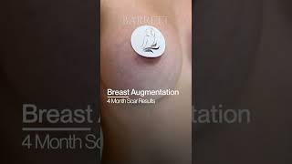 Famous Breast Augmentation 4 Months Later: Can You Spot The Scars? 👀✨ Net Worth