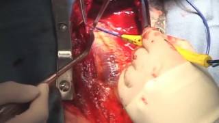 Heart Bypass Surgery video thumbnail