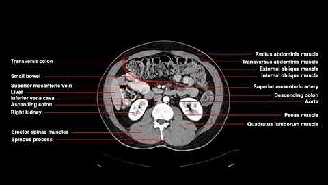 How is a CT scan of the abdomen performed? Procedures in computed tomography imaging