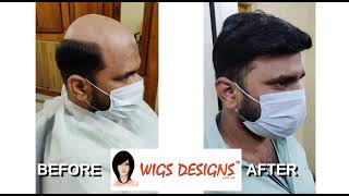 Non Surgical Hair Replacement in Bangalore | 9951223066