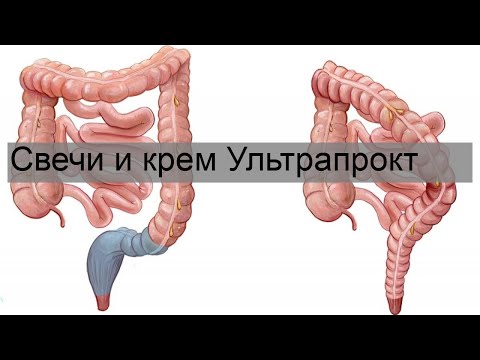 Свечи и крем Ультрапрокт