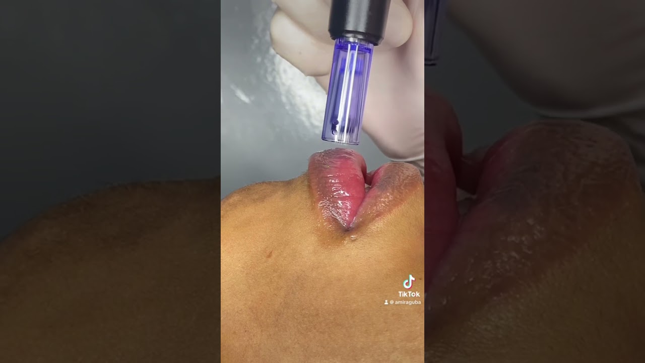 Lips microneedling