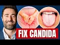 Get rid of candida  sifo in 4 simplified steps works fast