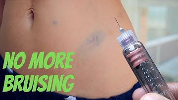 Stop Insulin Injection Bruising with These 6 Tried Tips