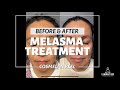 Cosmelan Peel for Melasma in Orange County with Results
