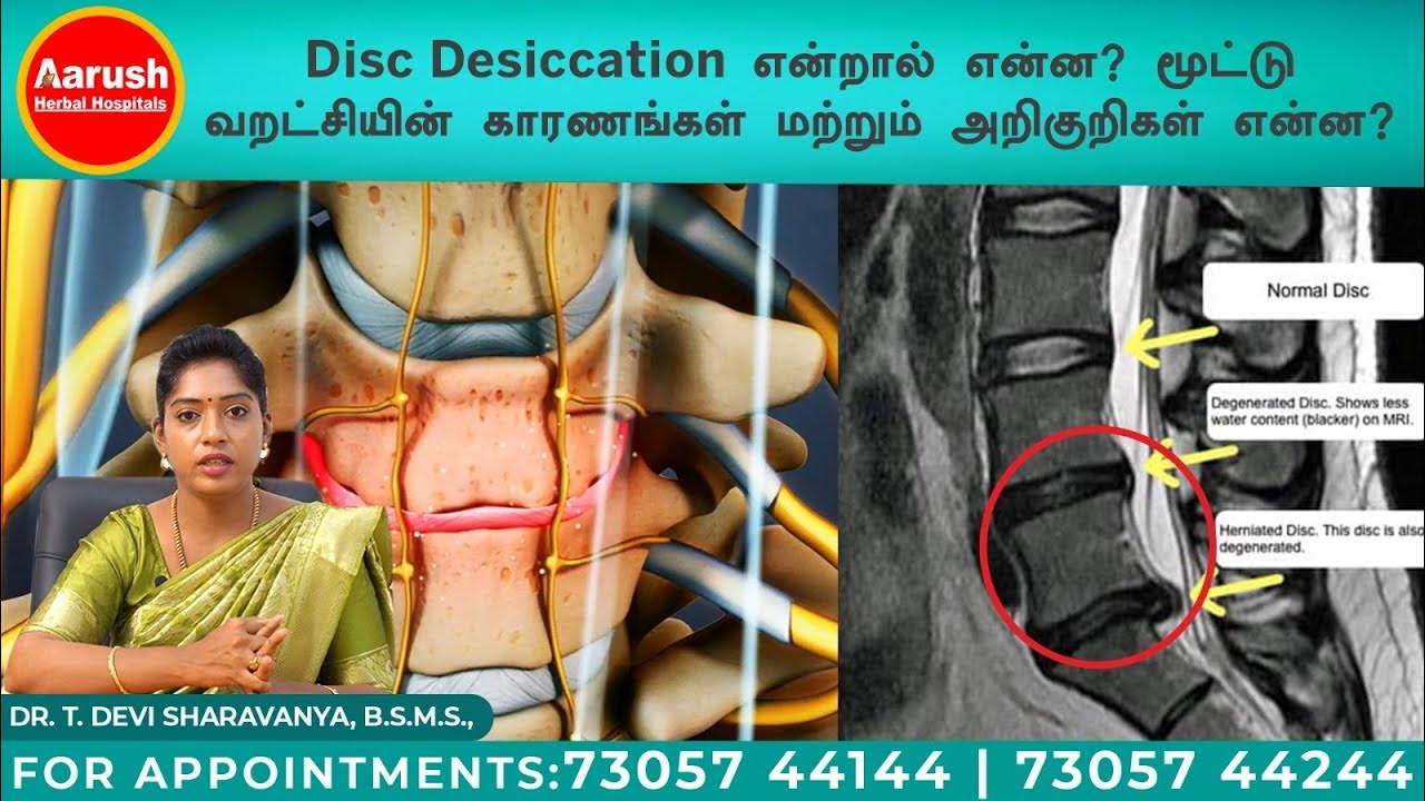 டிஸ்க் டெசிகேஷன் (Disc Desiccation) என்றால் என்ன?வட்டு வறட்சியின்