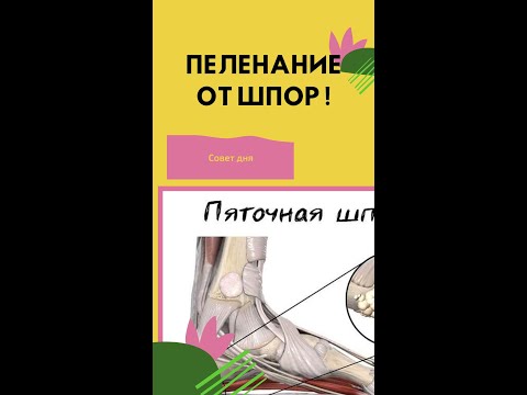 Пяточная шпора. Как я быстро ее вылечила. Простой метод.Рецепт № 1