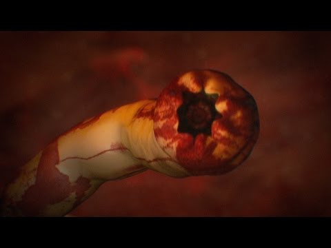 Surgery to Remove 8-inch-long Eyeball Worm | Monsters Inside Me