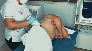 Proceso Liposonix