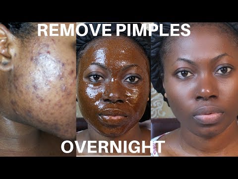 How To Remove Pimples Overnight | Acne Treatment