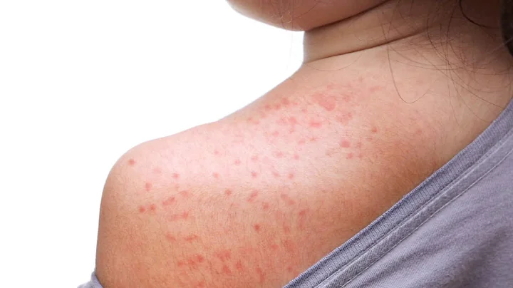 Bay Area health officials warn public as measles cases rise