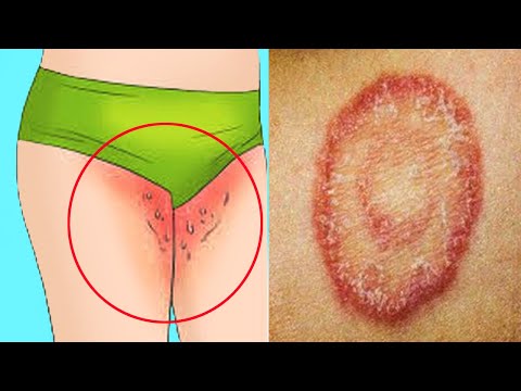 prevent and treat nail fungus! treat Private Part Itching, Fungal infection, burning, Yeast infectio