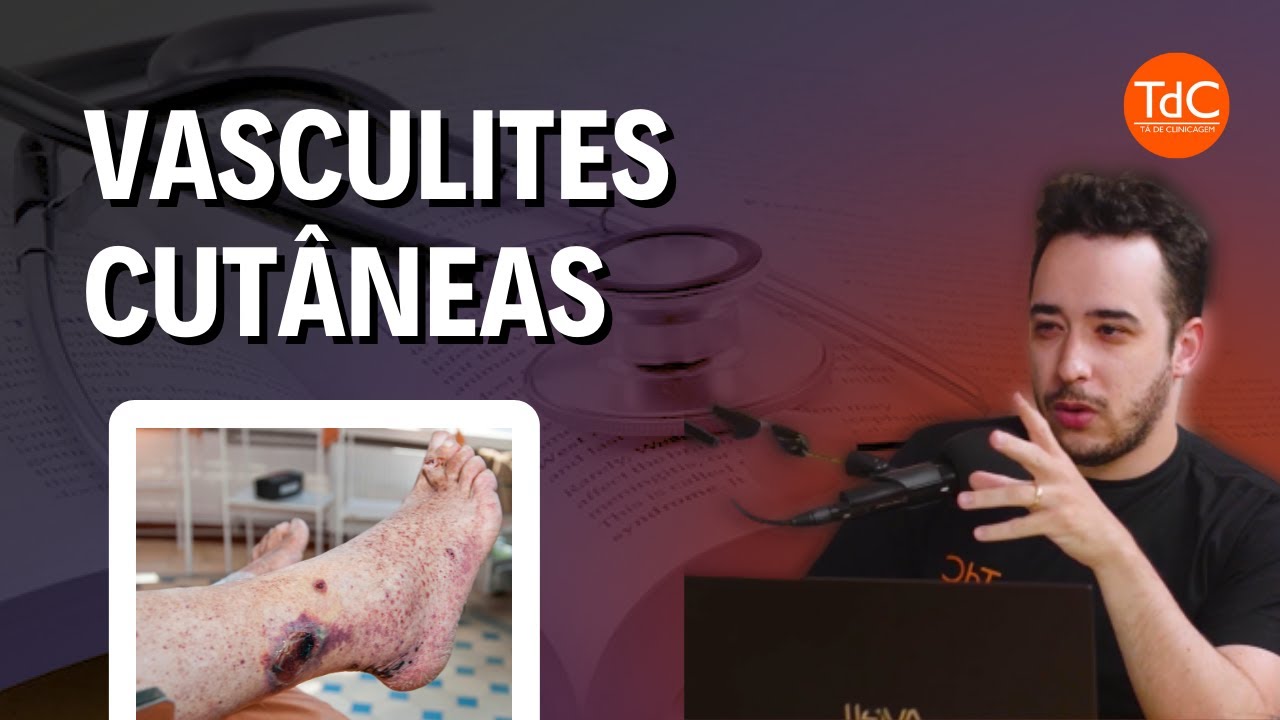 Thumbnail - Vasculite Cutânea: Dicas rápidas