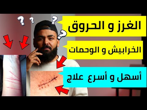 أسهل و أسرع علاج لمشاكل عيادة الجلدية الغرز الخرابيش الوحمات الحروق الأمراض الجلدية