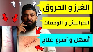 أسهل و أسرع علاج لمشاكل عيادة الجلدية : الغرز ، الخرابيش ، الوحمات ، الحروق الأمراض الجلدية .