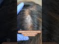 Houston alopecia doctor hairlosstreatment hairlossexpert smp trichologist hairrestoration