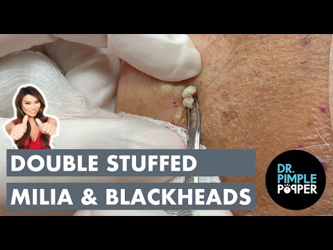 Double Stuffed Milia & Blackheads