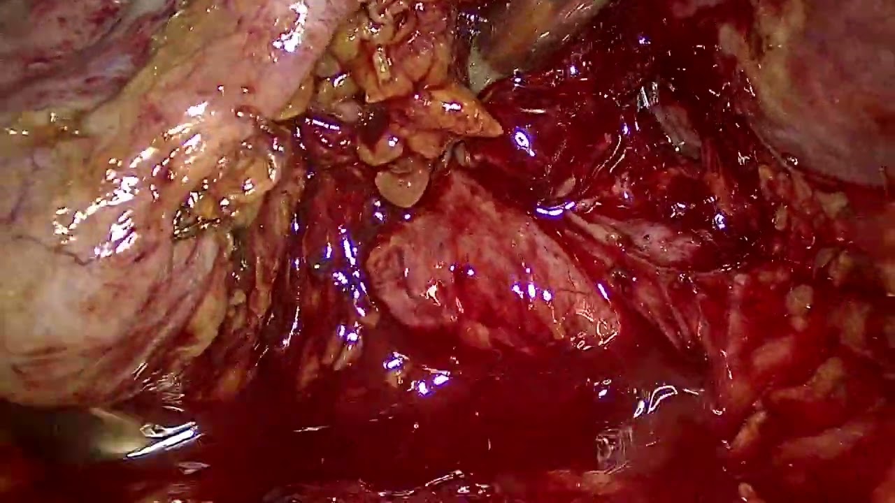 04072020 Laparoscopic cholecystectomy with intraoperative cholangiogram (LC+IOC) part 3