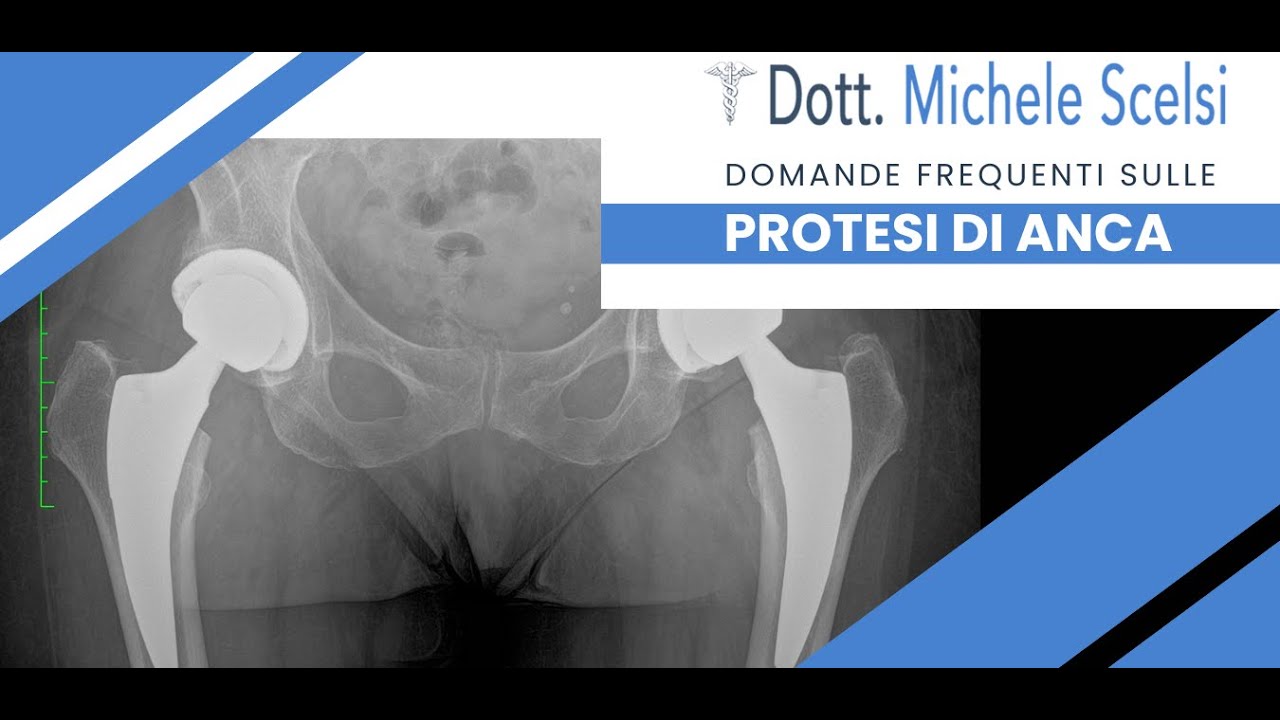 Il chirurgo ortopedico risponde alle domande frequenti sulla protesi d'anca. - Dott. Michele Scelsi