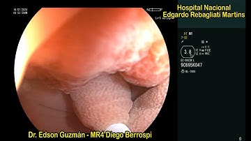 Underwater endoscopic mucosal resection (U-EMR) of a colonic large pedunculated polyp