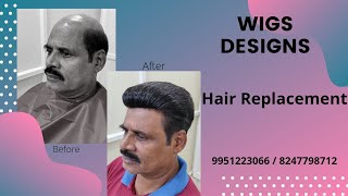 How To Do Hair Replacement in Bangalore | Hyderabad | 824778712 | 9951223066