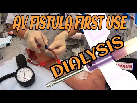 First time use of an AV Fistula at Stavanger University Hospital (HD)