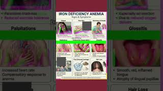 Iron deficiency anemia occurs when the body lacks sufficient iron to produce hemoglobin