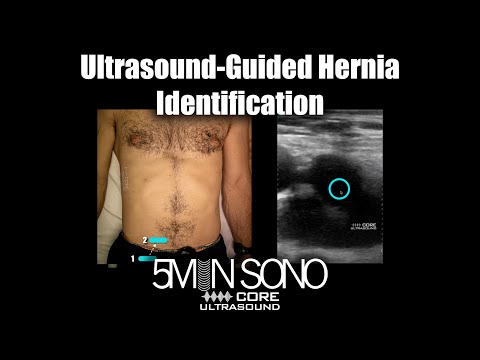 Image of Ultrasound-Guided Hernia Identification