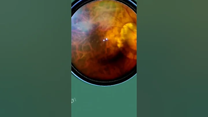 Smartphone Fundus Videography | Fundus Photography | Short Video 6