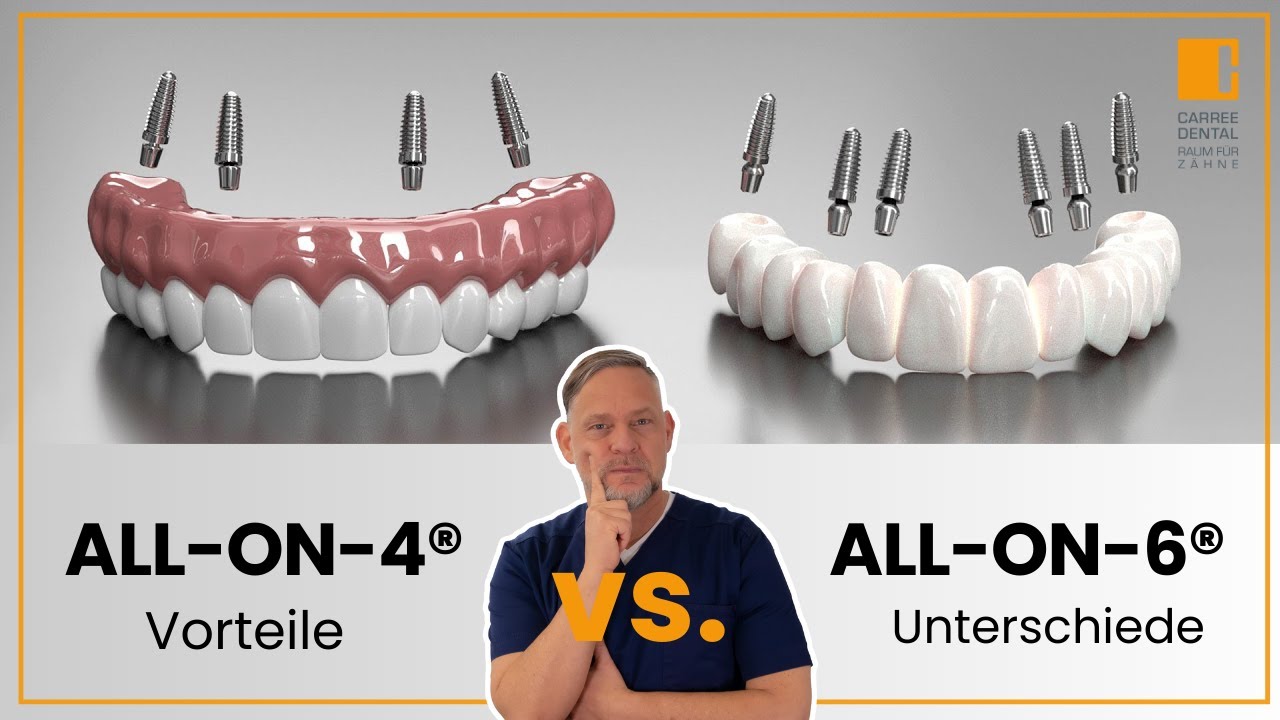 All-on-4® vs. All-on-6®: Festsitzender Zahnersatz - Implantate - Wann geeignet? | Carree Dental Köln