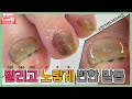 말리고 노랗게변한 발톱! - athlete's foot / tinea pedis / onychomycosis - 레푸스 남양주호평점 Refuss