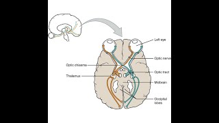 Mid Sagittal Lesion of the optic chiasma and its effect