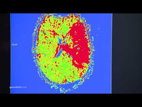 Video: Thrombektomie - Arten Der Operation, Indikationen, Ergebnisse