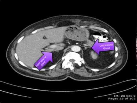 Video: Adenocarcinoma Of The Stomach, Uterus, Rectum