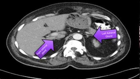 Clinical Case: Colon Cancer
