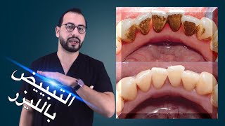 هل تبييض الاسنان بالليزر ضار ام مفيد؟ وما هي المده التي تظل فيها الاسنان بيضاء ؟| dental bleaching screenshot 3
