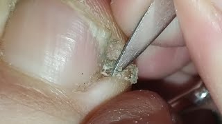Toenail cleaning. My friends I need your paypal support.