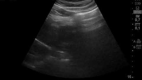Cystic Echinococcus (CE5)