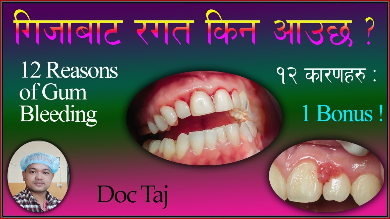 Causes of Gum bleeding /गिजाबाट रगत बग्ने 12 कारणहरु/gija bata ragat