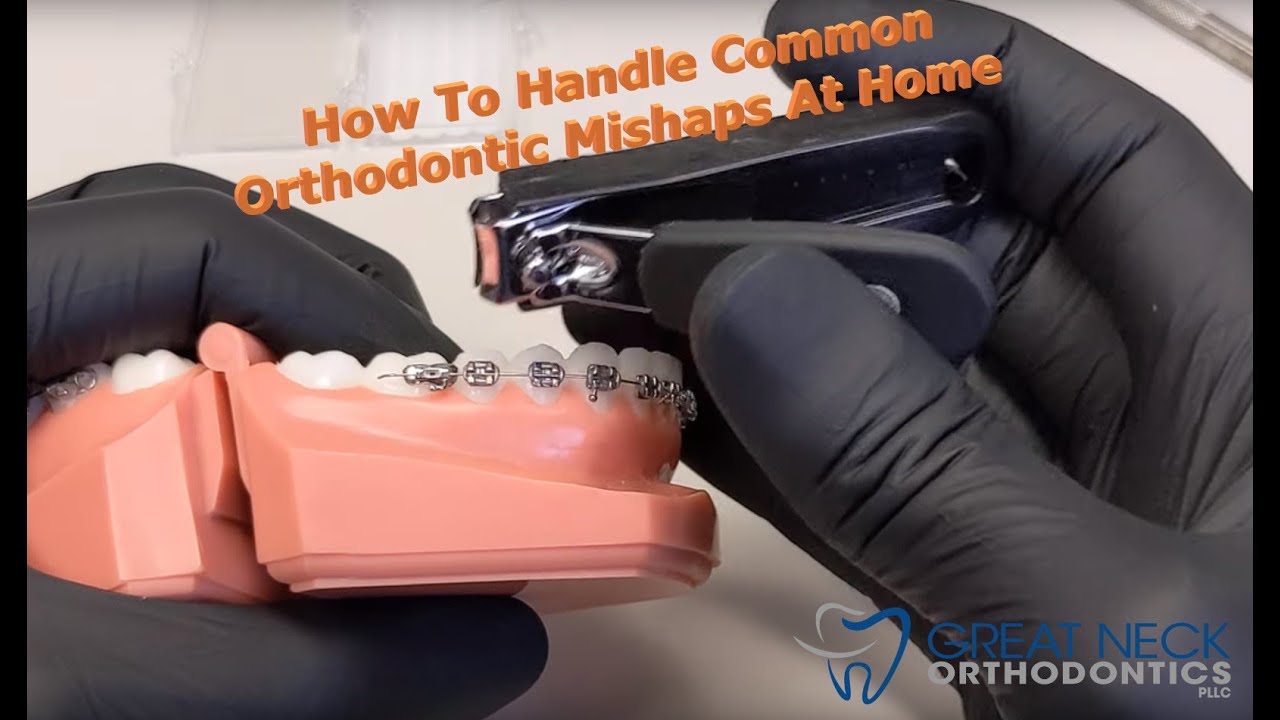 How to handle simple orthodontic "emergencies" at home YouTube