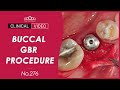 Simple buccal gbr with membrane punch dr kim jaeyoon