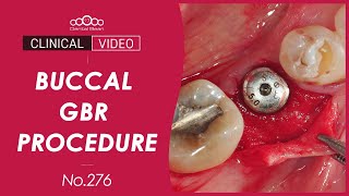 Simple buccal GBR with membrane punch [Dr. Kim Jaeyoon] screenshot 4