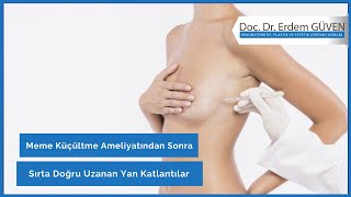 Meme Küçültme Ameliyatından Sonra Sırta Doğru Uzanan Yan Katlantılar Doç.dr.erdem Güven