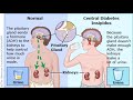 Central Diabetes Insipidus