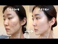 3 Secrets To Clearing Acne Without Medication No Accutane Tretinoin