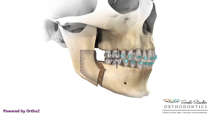 BSSO Mandibular Advancement - DayDayNews